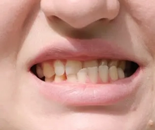 Overbite Underbite Crossbite